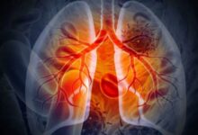 Photo of फेफड़ों के कैंसर के खिलाफ बड़ी कामयाबी